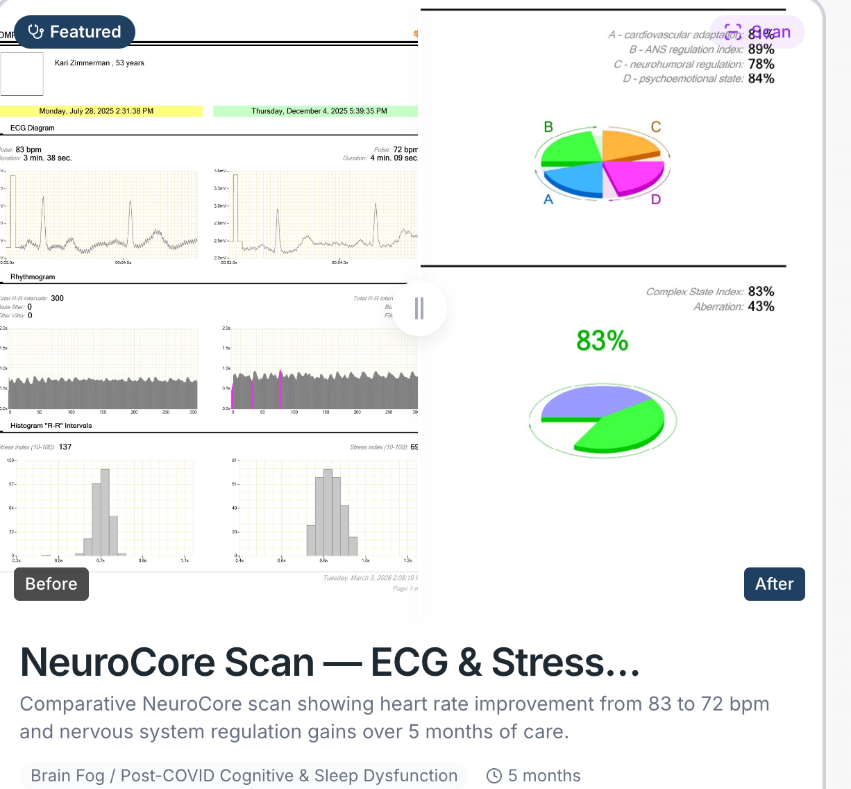 Visual evidence of Seasonal Depression / Nervous System Dysregulation treatment outcome showing Stress Index reduced from 69 to 28 (59% reduction). Energy balance improved from 0.83 to 1.21. ANS regulation improved from 80% to 100%. Biological age reduced from 41 to 36. over Approximately 4 months (Oct 2025 – Jan 2026)